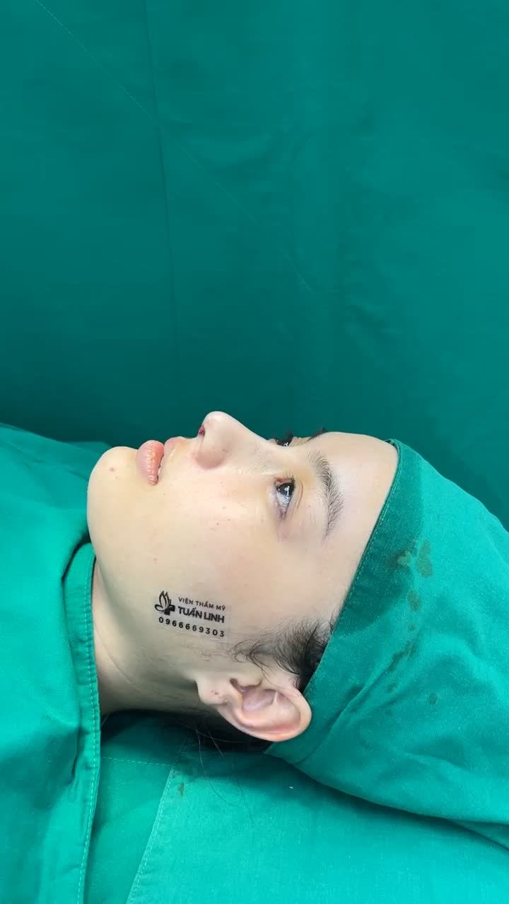 Case mũi cấu trúc surgiform vừa hoàn thành